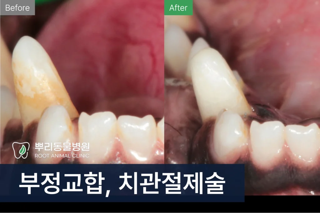 부정교합 치관절제술