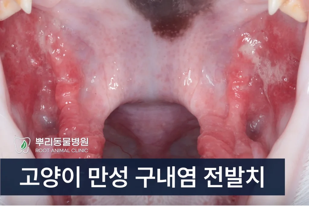 만성구내염 전발치