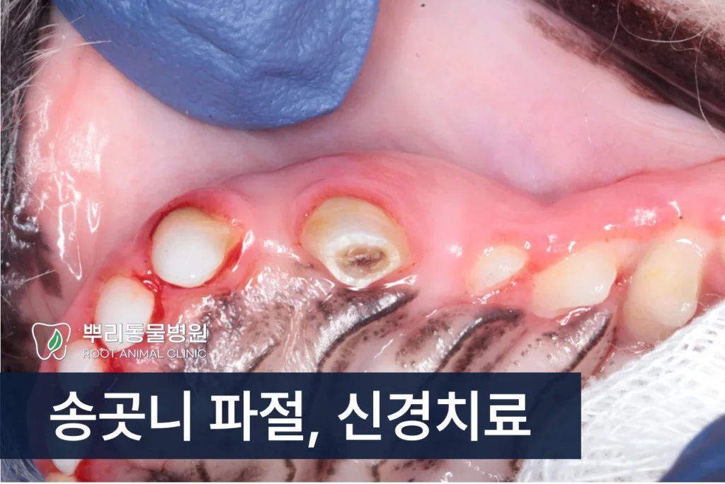 송곳니 파절 신경치료