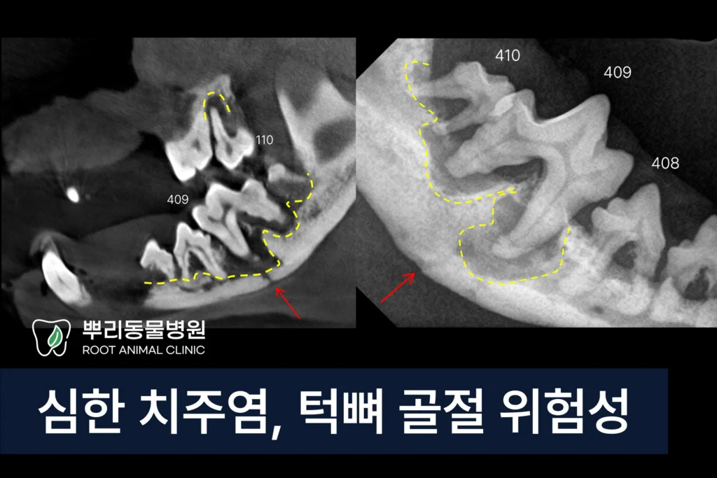 심한 치주염 턱뼈골절