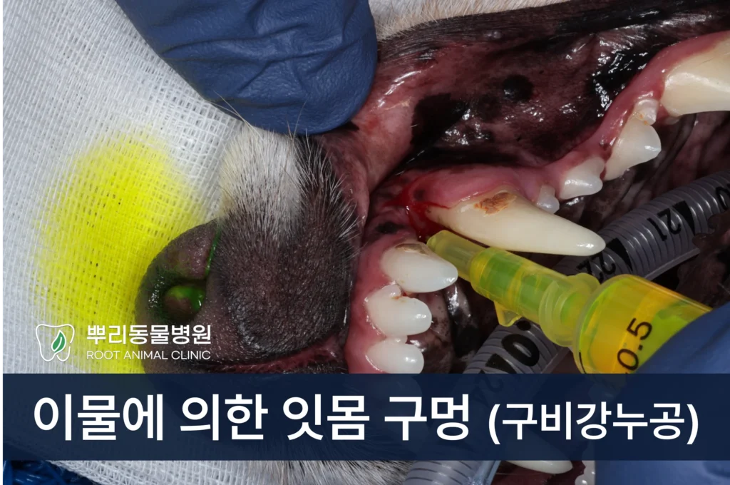 이물 구비강누공 수술