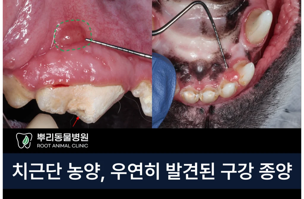 치근단농양 구강 종양 4